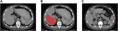 Clinical-radiomic analysis for non-invasive prediction of liver steatosis on non-contrast CT: A pilot study